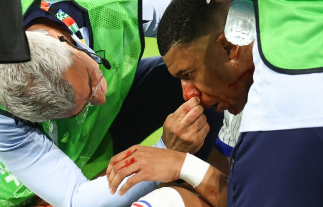 Mbappe to wear mask on broken nose, doctors concerned about breathing